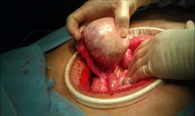 Recurrent-GIST-tumor-for-resection-from-abden1.jpg